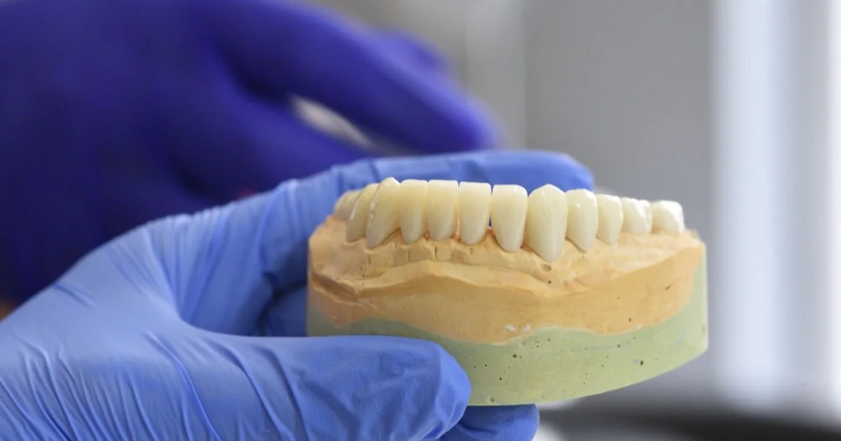 Full-arch dental implant model
