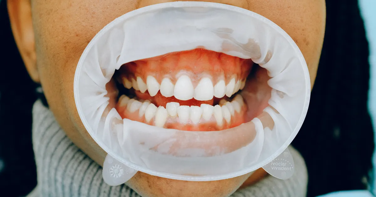 Diş əti müayinəsi