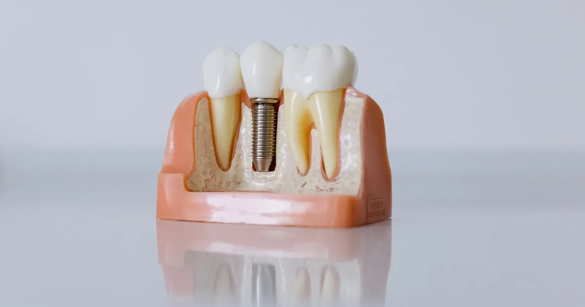 Diş implantı modeli