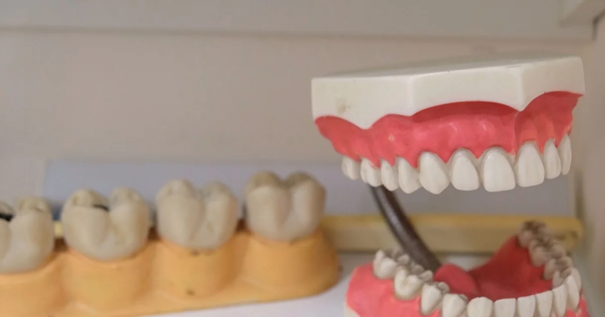 Close-up of dental bite models