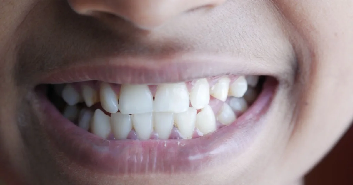 Close-up smile showing the front teeth