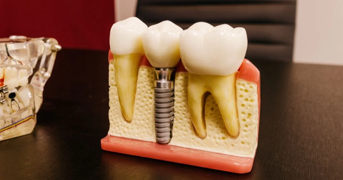 Implant model on a work desk