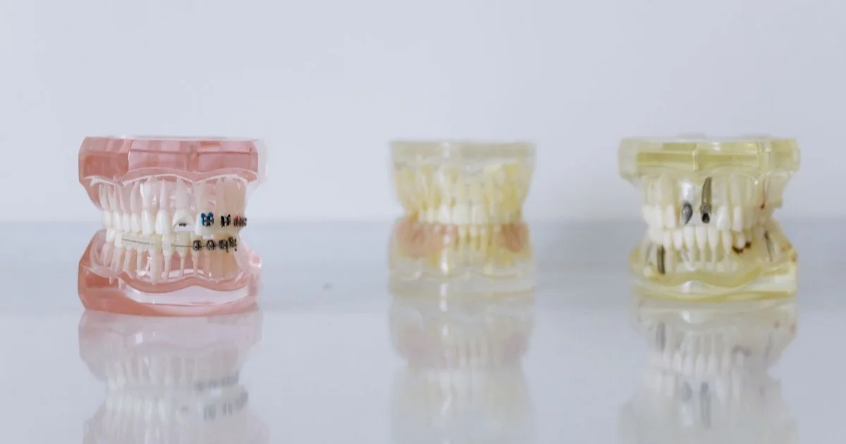 Close-up of dental models