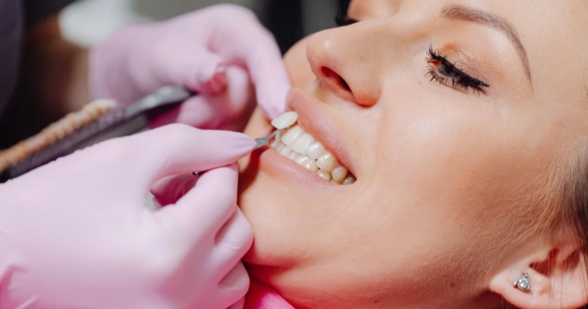 A veneer being placed on a woman