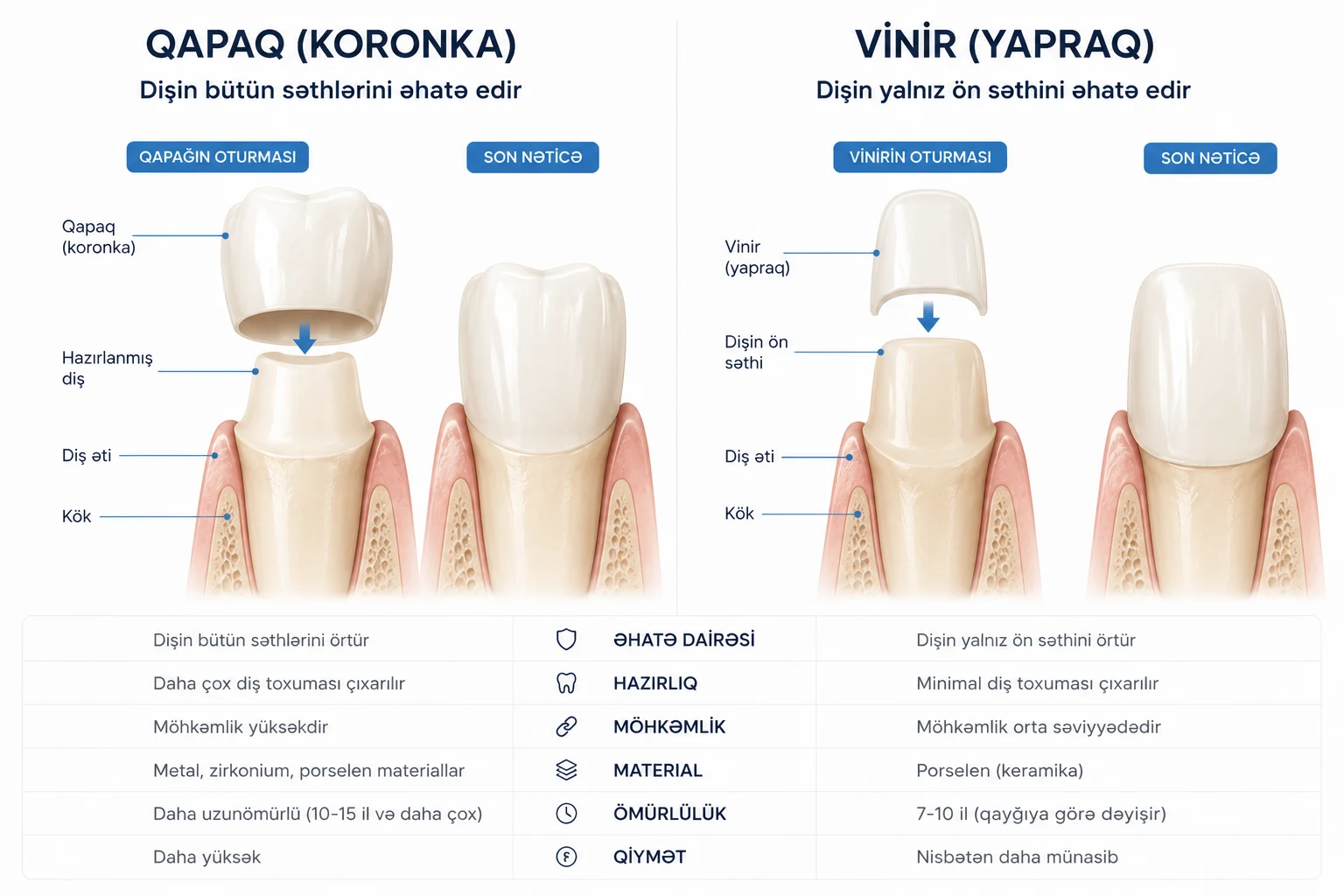 Qapaq (koronka) və vinir (yapraq) müqayisəsi: qapaq dişin bütün səthlərini, vinir yalnız ön səthini örtür — hazırlıq, möhkəmlik, material, ömür və qiymət fərqi