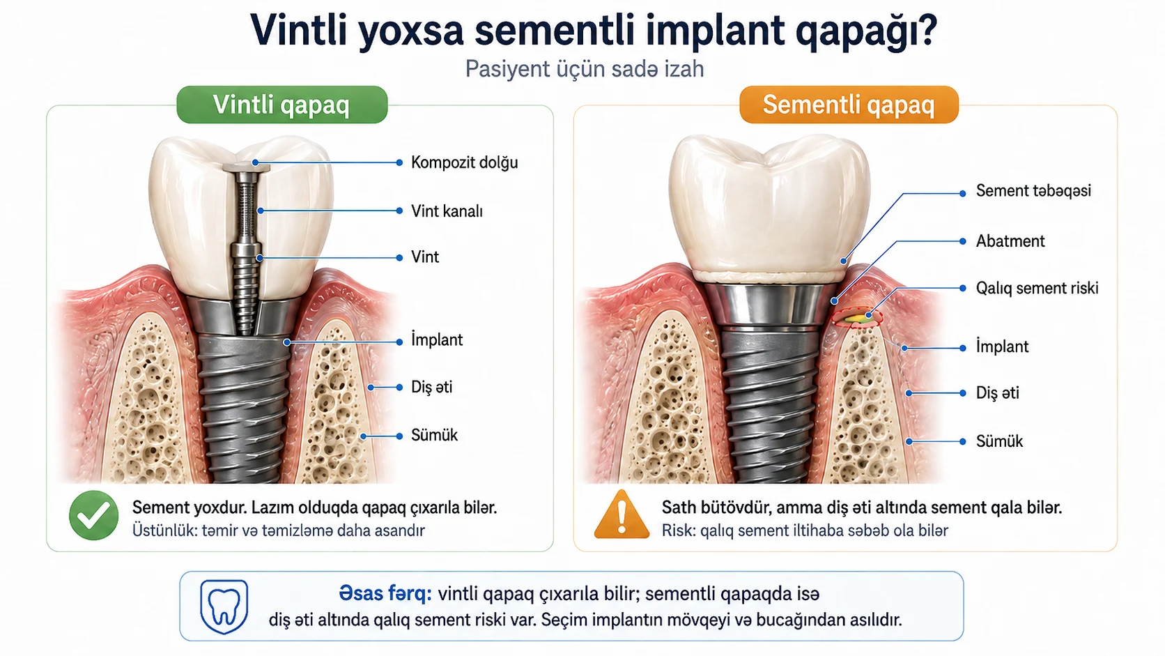 Vintli və sementli implant qapağının kəsik müqayisəsi: vint kanalı, kompozit dolğu, abatment, sement təbəqəsi və qalıq sement riski