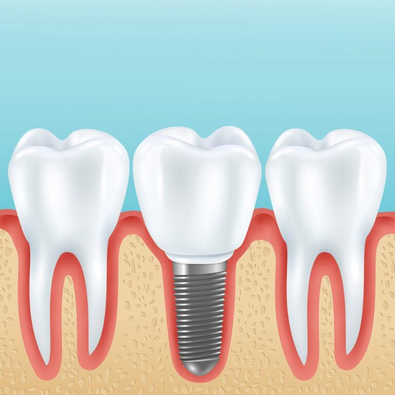 implant-sikca-sorulan-sorular-1024x1024